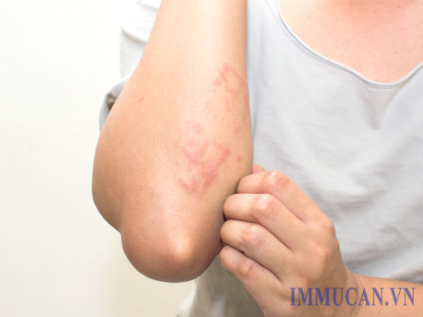 Bệnh ngứa theo mùa